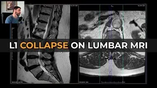 Thumbnail: Lumbar MRI Decoded: Old Fracture or Acute Collapse?