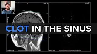 Thumbnail: Dural Sinus Thrombosis on MRI: Slow Flow or Clot?
