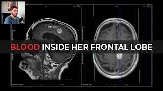 Thumbnail: Acute Brain Hematoma on MRI: The Geriatric Disaster
