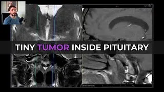 Thumbnail: Pituitary Microadenoma MRI: 4 Empty Sella Signs