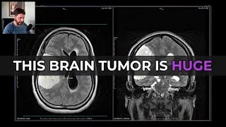 Thumbnail: Massive 7.6 cm Brain Tumor on MRI: Meningioma or HPC?