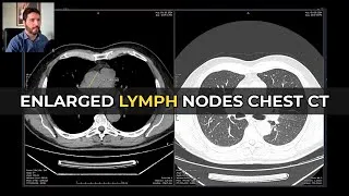Thumbnail: Elderly Chest CT: 5 Findings You Must Report Every Time