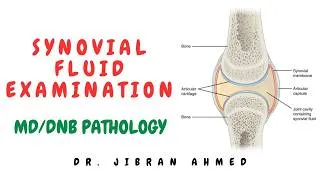 Thumbnail: SYNOVIAL FLUID EXAMINATION II MD DNB PATHOLOGY II SIMPLY PATHOLOGY II CLINICAL PATH