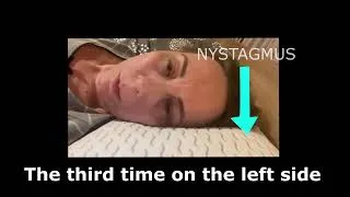 Thumbnail: Treatment-Resistant Horizontal Canal BPPV | Severe Positional Vertigo