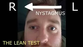 Thumbnail: Horizontal Canal BPPV Cupulolithiasis Case | Ageotropic Nystagmus Explained