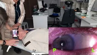 Thumbnail: BPPV Testing Reveals Unilateral Vestibulopathy with Spontaneous Nystagmus