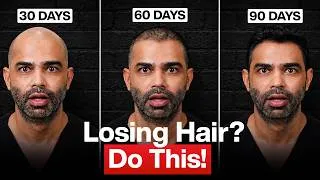 Thumbnail: If I Started Losing Hair Today, Here's What I'd Actually Do!