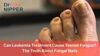 Thumbnail: Can Leukemia Treatment Cause Toenail Fungus? The Truth About Fungal Nails