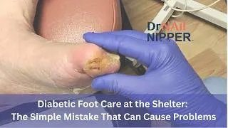 Thumbnail: FEET-ure Friday | Diabetic Foot Care at the Shelter: The Simple Mistake That Can Cause Problems
