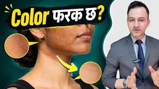Thumbnail: DARK SPOTS in Skin | How to treat