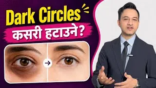 Thumbnail: 10 mistakes that increase your under eye dark circles and puffiness - by dermatologist