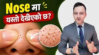 Thumbnail: Sebaceous Filaments - What are they? How to treat?