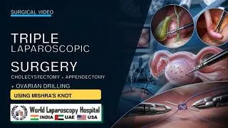 Thumbnail: Triple Laparoscopic Surgery: Cholecystectomy, Appendectomy & Ovarian Drilling Using Mishra’s Knot