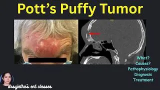 Thumbnail: 280.“Forehead Swelling? Think Pott’s Puffy Tumor | ENT Emergency Explained”  #ent