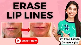 Thumbnail: Erase Lip Lines: Top Skincare and Cosmetic Solutions from a Dermatologist