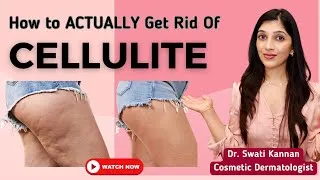 Thumbnail: The Truth About Cellulite: Treatments That Actually Work