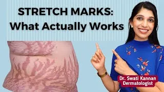Thumbnail: Fade Stretch Marks: Products and Treatments That Actually Work