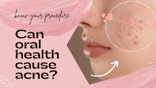 Thumbnail: Can oral health cause acne?- Know your procedure