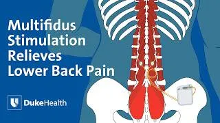 Thumbnail: Multifidus Stimulation Relieves Lower Back Pain | Duke Health
