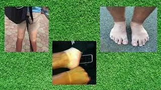 Thumbnail: Golf Tan Lines
