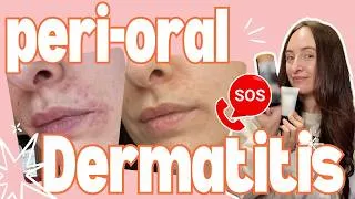 Thumbnail: Healing My Own PERIORAL DERMATITIS ❤️‍🩹 as a NATUROPATHIC NUTRITIONIST