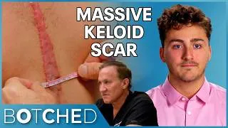Thumbnail: Joshua Has A Massive Keloid Scar After Childhood Open Heart Surgery | Botched | E!