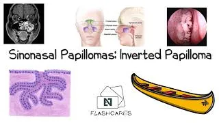 Thumbnail: Inverted Papilloma - FRCS ENT Exam Essentials