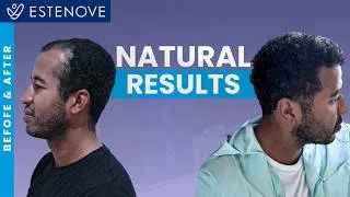 Thumbnail: From Receding Hairline to Natural Density: Daniel’s 6-Month Progress