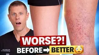 Thumbnail: 7 things you need to know before you do Sclerotherapy for Spider Veins 😳