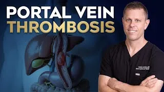 Thumbnail: What Is Portal Vein Thrombosis?