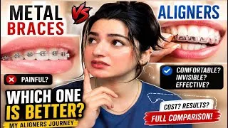 Thumbnail: My Aligners Journey After Months | Are Aligners Worth It? Or metal braces?