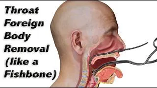 Thumbnail: How a Fishbone (or Other Foreign Body) is Removed from the Throat Without Sedation