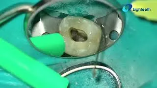 Thumbnail: POV clinical presentation of RCT of tooth 14 from start to finish using @FlexivoDental products. 