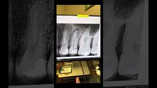 Thumbnail: It’s all about irrigation and activation. #dentists #rootcanaltherapy 