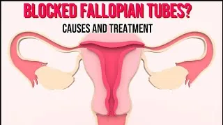 Thumbnail: Blocked Fallopian Tubes? Causes, Signs & Treatment Options