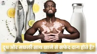 Thumbnail: दूध और मछली साथ खाने से सफेद दाग होते हैं? सच या अफ़वाह! Vitiligo Myths @FitnessFighters