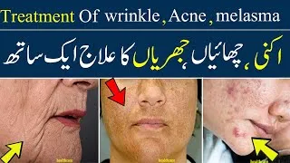 Thumbnail: treatment of melasma || discoloration on face || acne ||  blemishes || pimples on scalp || wrinkle
