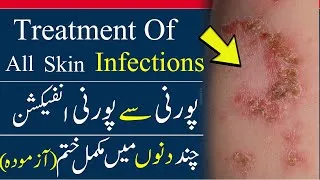 Thumbnail: skin infection ka ilaj || ringworm || athlete's foot || foot fungus || best antifungal
