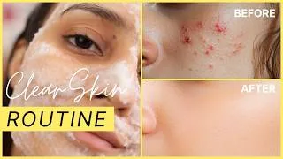 Thumbnail: How To Remove Pimples & Acne From Face At Home | Clear Skin Home Remedies | Glamrs