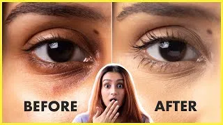 Thumbnail: Remove Dark Circles Under Eyes Naturally At Home! Every Dark Circle Remedy | Glamrs