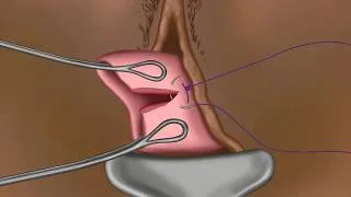 Thumbnail: Cervical Tears (Burmese) - Childbirth Series