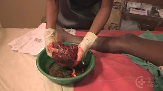 Thumbnail: Examining the Placenta (Burmese) - Childbirth Series