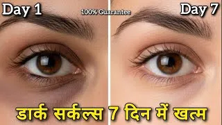 Thumbnail: 18-30 Age में डार्क सर्कल्स बढ़ते जा रहे हैं? 5 ऐसे तरीके जिससे 7 दिन में खत्म! #darkcircles 