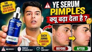 Thumbnail: The Derma Co Salicylic Acid Serum Review | Acne, Pimples & Oily Skin Ke Liye Bekar Hai?