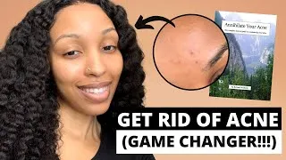 Thumbnail: Annihilate Your Acne: Richard Wolfstein e-book [Spoiler Alert: You NEED This.]