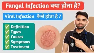 Thumbnail: Fungal Infection Kya Kota Hai | Types, Causes, Symptoms And Treatment of Fungal Infection