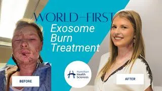 Thumbnail: World-first exosomes burn treatment at Hamilton Health Sciences