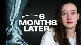 Thumbnail: My Leg Got Crushed Rock Climbing, Now What?