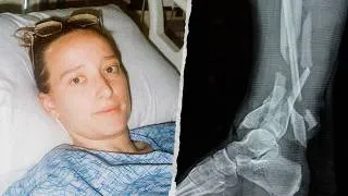 Thumbnail: I Nearly Lost My Leg In a Rock Climbing Accident