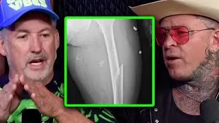Thumbnail: Harland Williams On Breaking His Femur Bone
